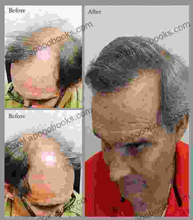 A Satisfied Patient Showing Off Their Successful Hair Transplant Results Practical Aspects Of Hair Transplantation In Asians