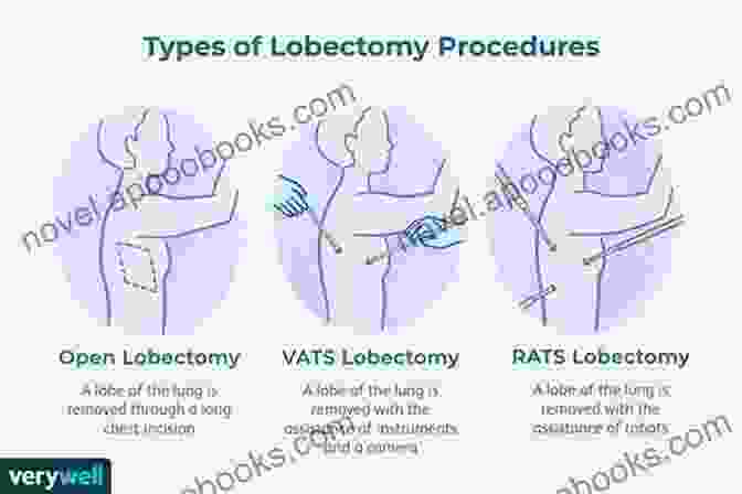 Illustration Of A Lobectomy Procedure Thoracic Surgery: Lung Resections Bronchoplasty (Master Techniques In Surgery)