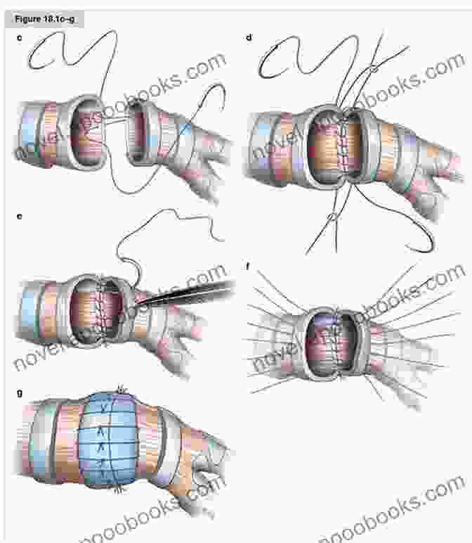 Illustration Of A Sleeve Resection And Bronchial Anastomosis Procedure Thoracic Surgery: Lung Resections Bronchoplasty (Master Techniques In Surgery)