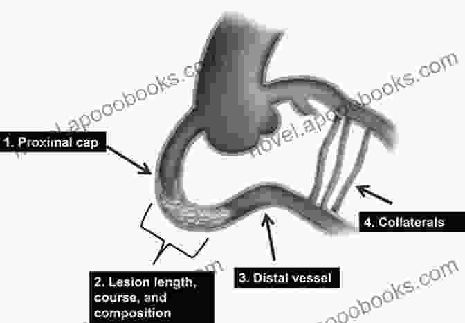 Percutaneous Intervention For Coronary Chronic Total Occlusion Percutaneous Intervention For Coronary Chronic Total Occlusion: The Hybrid Approach