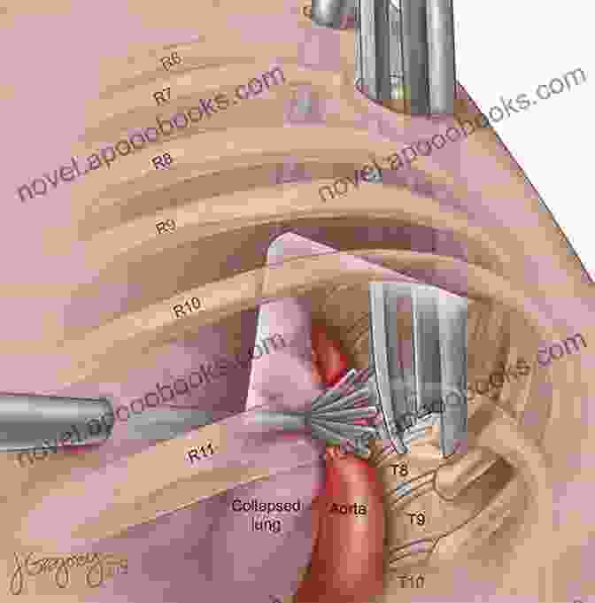 VATS Surgical Illustration Atlas Of Minimally Invasive Thoracic Surgery (VATS): Expert Consult