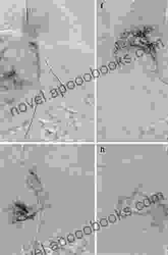 Therapeutic Embolization Nick Pulford